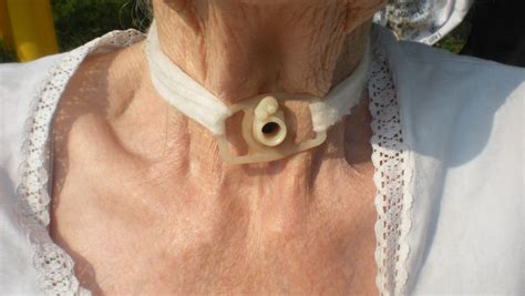 tracheostomy care  home caring  tracheostomy aspire uk
