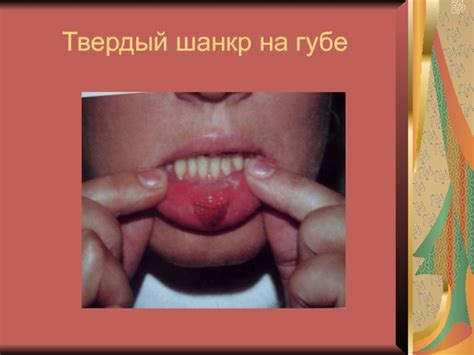 Сифилис презентация, доклад