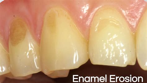 enamel erosion   tooth enamel loss    protect