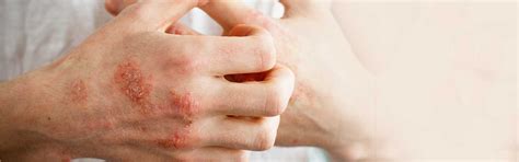 Eczema - Dermatologist