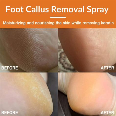 Foot Callus Removal Spray 2PCS - Instant Peel-Off Spray for Cracked