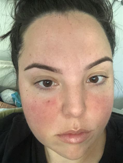 Moles/freckles on face : r/Melanoma