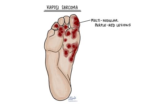 Your pathology report for Kaposi sarcoma | MyPathologyReport