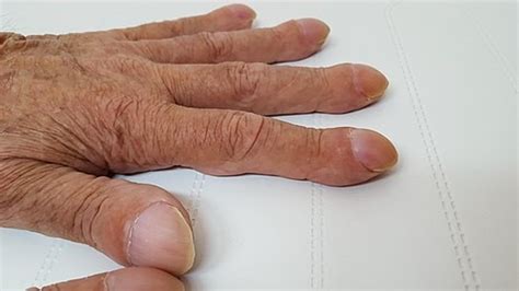 Toe and Finger Clubbing (Causes, Symptoms and Treatment)