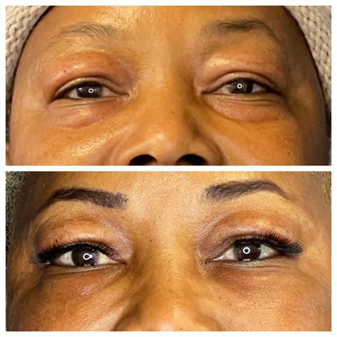 Lower Eyelid Bags - Echelon Surgical Specialists