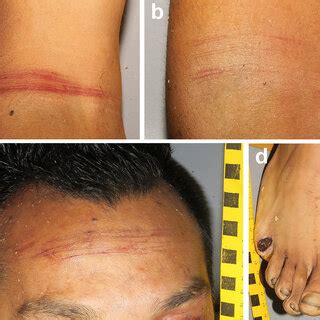 The photographs taken at the autopsy: multiple superficial cut wounds ...