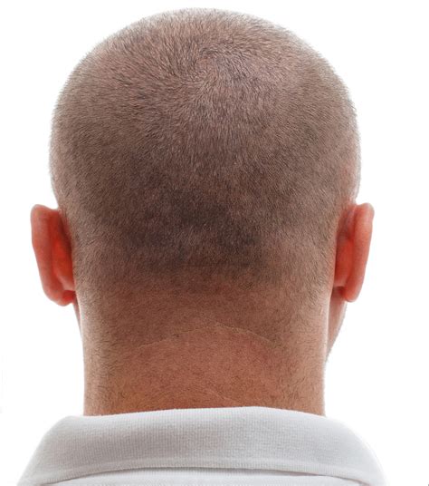 pakistan aesthetic hair transplant center  drhanif saeed