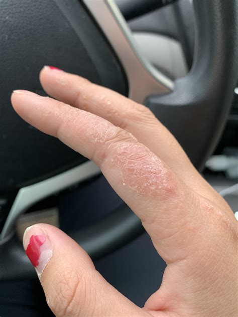 My hand looks like this year-round. Sometimes it bleeds and hurts a lot