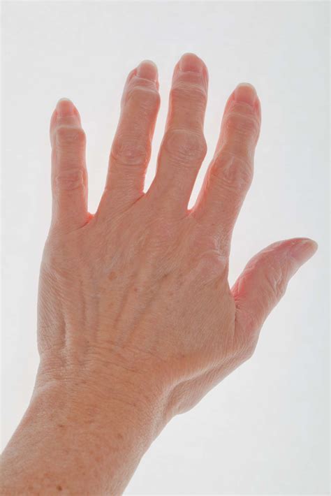 Early Arthritis in Fingers: Symptoms and Treatment