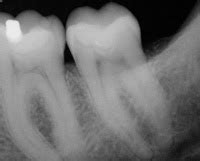 endodontic mandibular  molar