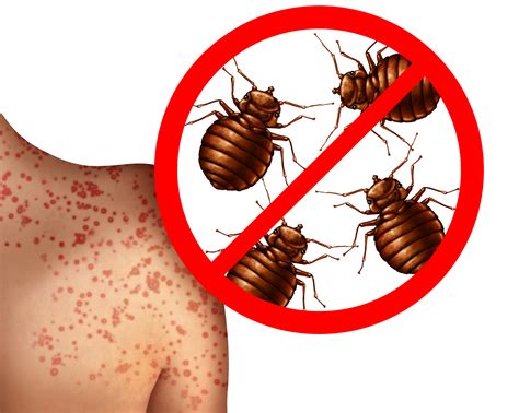 Risk Of Bed Bugs at Sabrina Evans blog