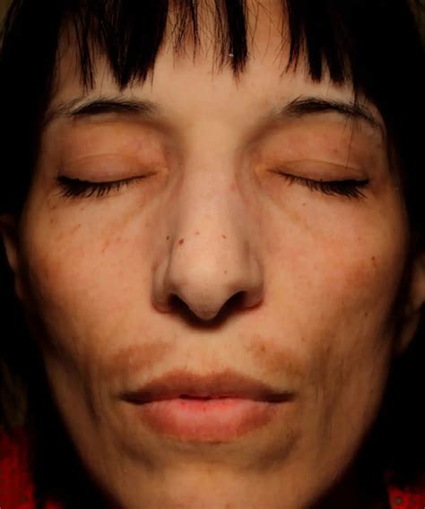 Kilmore Cosmetic Clinic: Skin Peels for Renewed Radiance