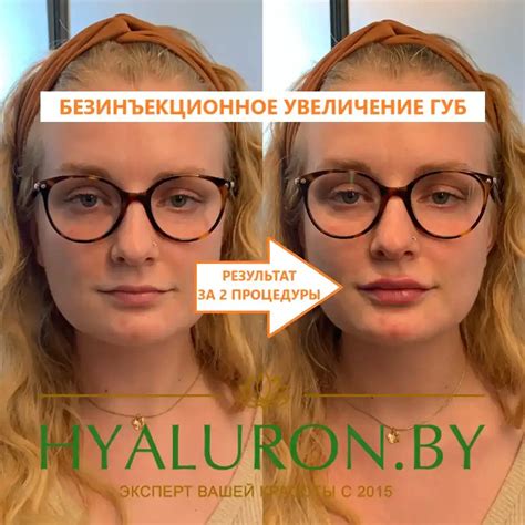 Stylage (Стилаж)филлер в Минске - Узнайте о препарате