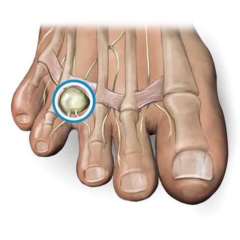 mortons neuroma wikism sports medicine wiki