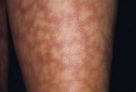 Еритема: види і шкірні прояви, лікування, фото » журнал здоров'я iHealth