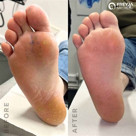 Wart Treatments — Freyja Medical