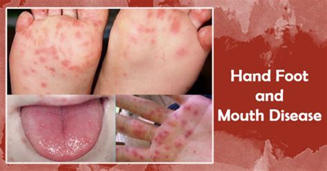 Information On Hand Foot Mouth Disease Outlet | emergencydentistry.com