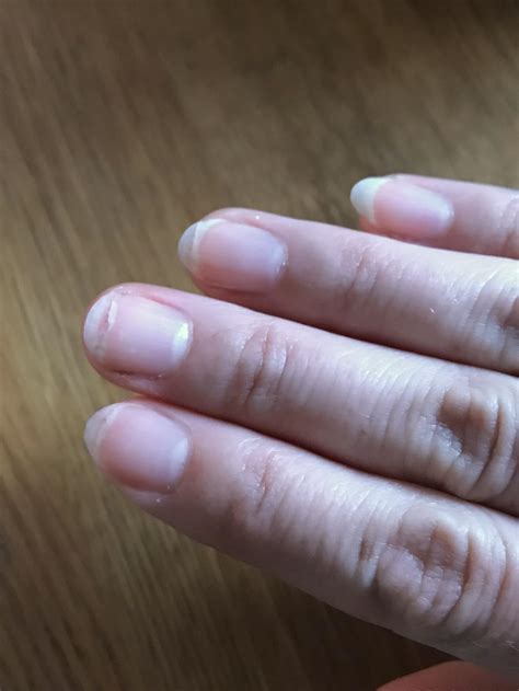 Vitamin D Deficiency Nails 5 Causes Of White Spots On Nails (With