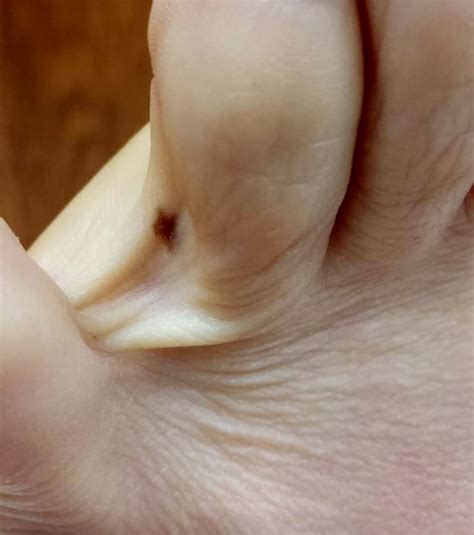 Melanoma Foot