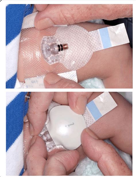 Blood Glucose Monitoring In Neonates at Gladys Davy blog