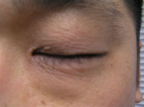 Eczema On Eyelid