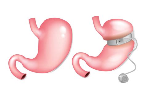 gastric band life  obesity