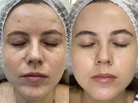 PRX-T33 - Esthetic Clinic