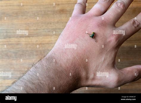 Wasp Sting Infection Signs Bee And Wasp Stings