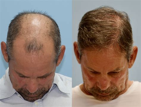 fue hair graft hair surgery carolina hair surgery