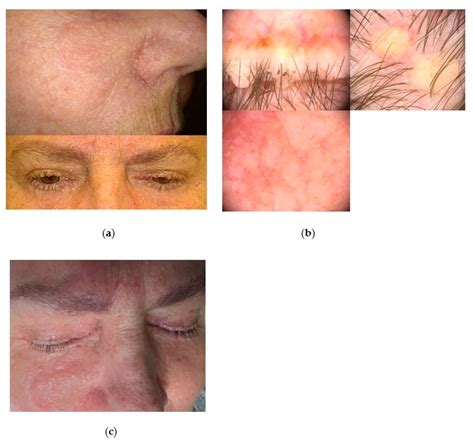 Minimally Invasive Plasma Device Management of Multiple Benign Skin