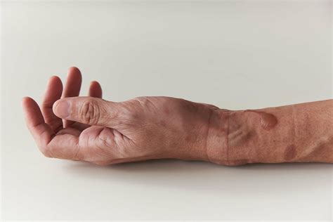 Wound Care: What Second-Degree Burn Looks Like — WoundCare University