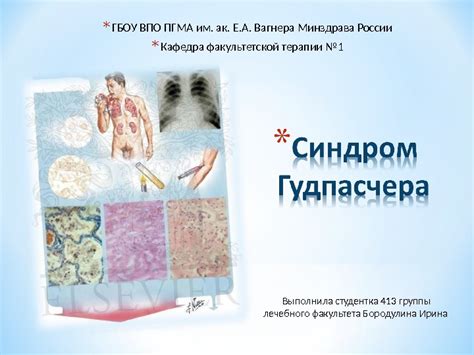 Презентация Синдром Гудпасчера
