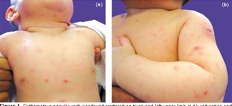 Figure 1 from Acute miliary tuberculosis in a five-month-old boy ...