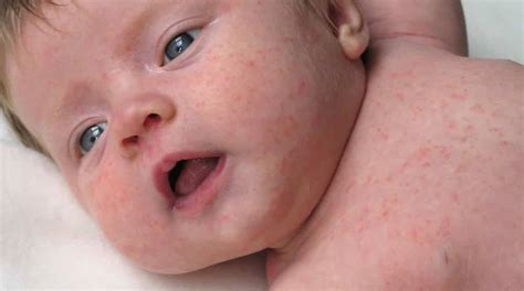 Como E Catapora Em Crianças - Catapora em crianças: como tratar e prevenir a doença - Bebê Mamãe