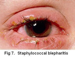 bacterial blepharitis blepharitis xbqb
