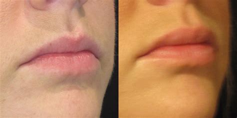 Lip Fillers Before and After Photos Milwaukee, WI