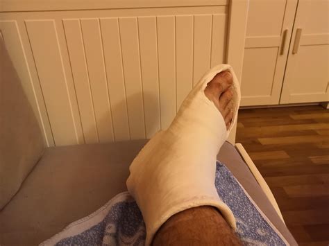 Even though I walked with chipped little bit of bone for 4 weeks, I