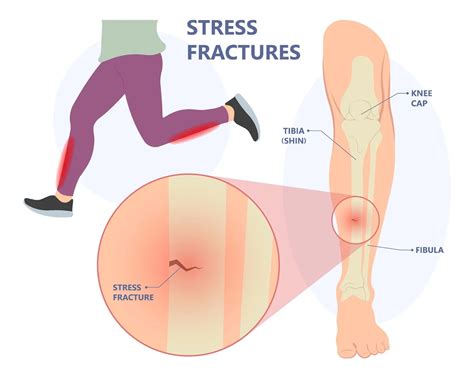 hairline fracture  symptoms care