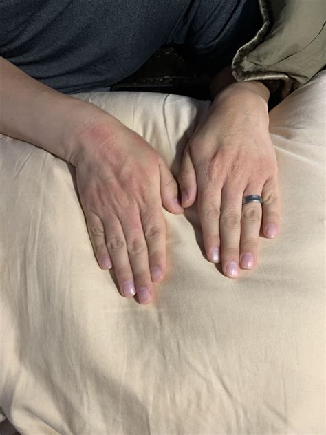 Any know if this is the Lamotrigine skin rash? It’s no where else on my