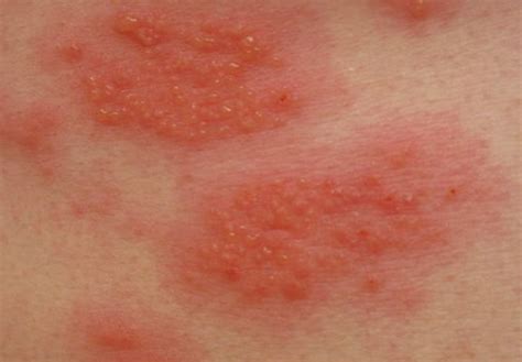 Contact Dermatitis - Pictures, Symptoms, Causes, Treatment | HubPages