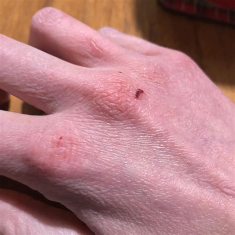 Is this eczema? Very dry & tight, cracking and bleeding often | no itch
