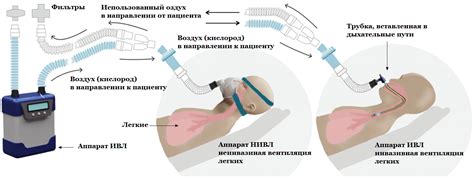 Аппараты ИВЛ для медучреждений и дома – интернет-магазин кислородного ...