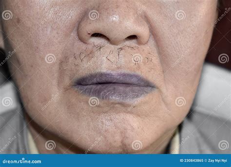 Central Cyanosis