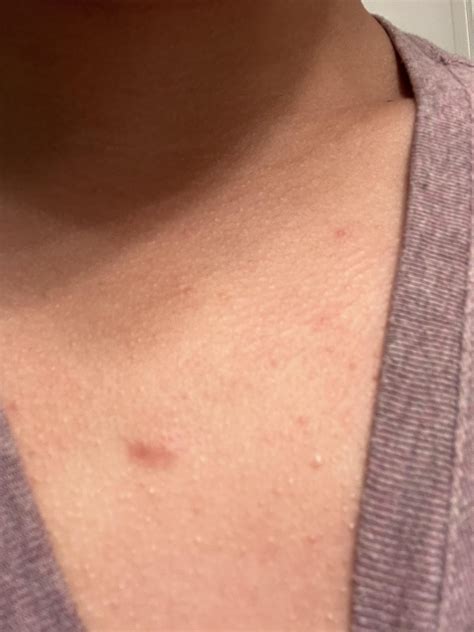 Painless bumps that’s been here for what seems over a year do anyone