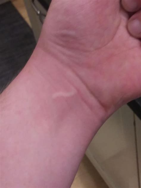 Weird spider bite looks like a worm inside my arm : r/Weird
