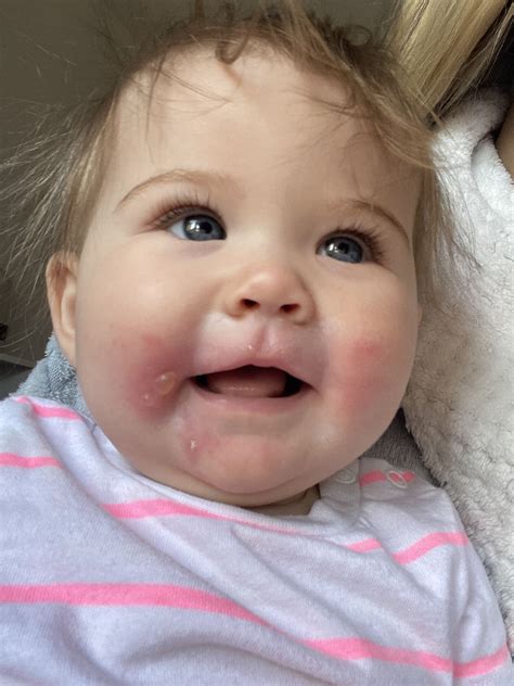 Mum’s horror after popular kids snack leaves baby covered in