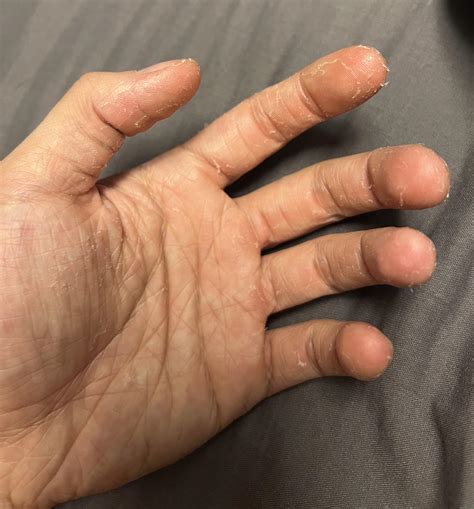 Skin on hands and feet randomly peeling. Any advice? : r/AusSkincare