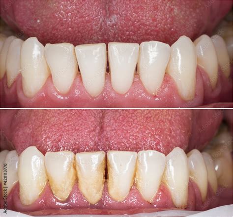 before and after picture for teeth cleaning Stock Photo | Adobe Stock