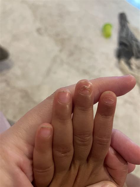 Reasons Why Fingernails Fall Off