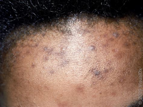 black spots  body disease infoupdateorg
